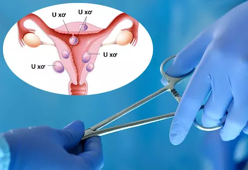 Có một số trường hợp nên cắt tử cung khi bị u xơ